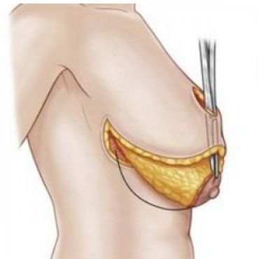 Пластическая операция по уменьшению груди