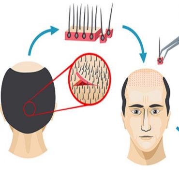Органическая трансплантация волос (FUT)